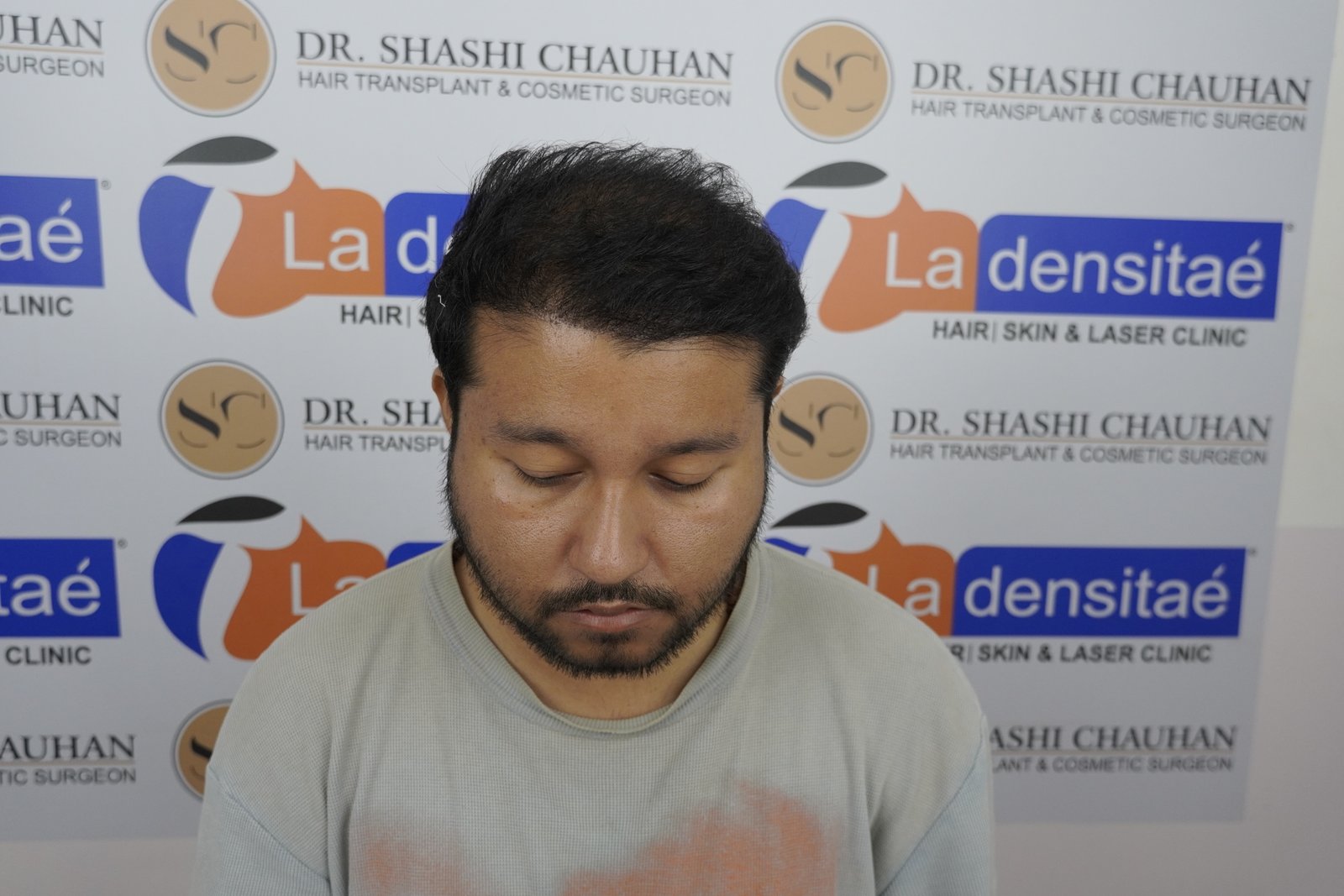 Dr. Bishal After Hair Transplant